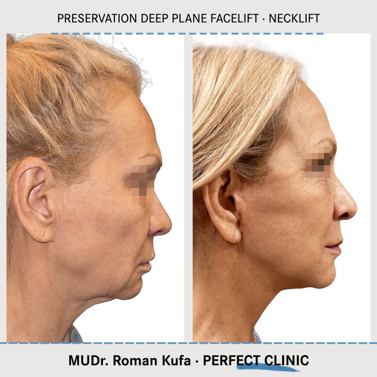 Facelift • Necklift