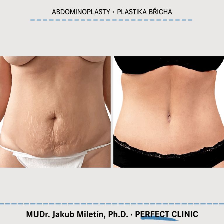 Abdominoplastika