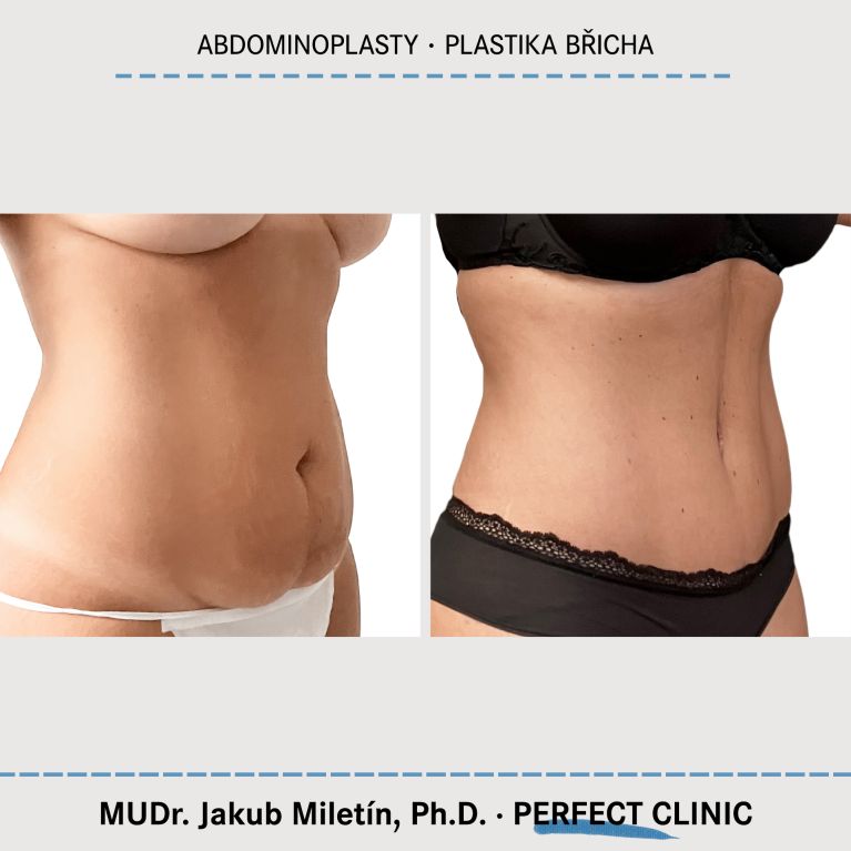 Abdominoplastika