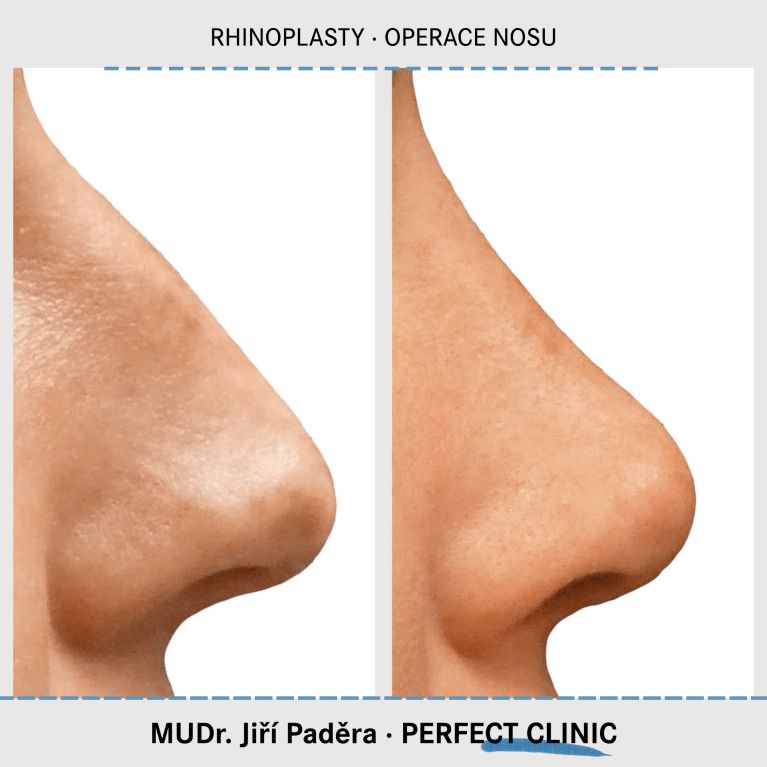 Rhinoplastika