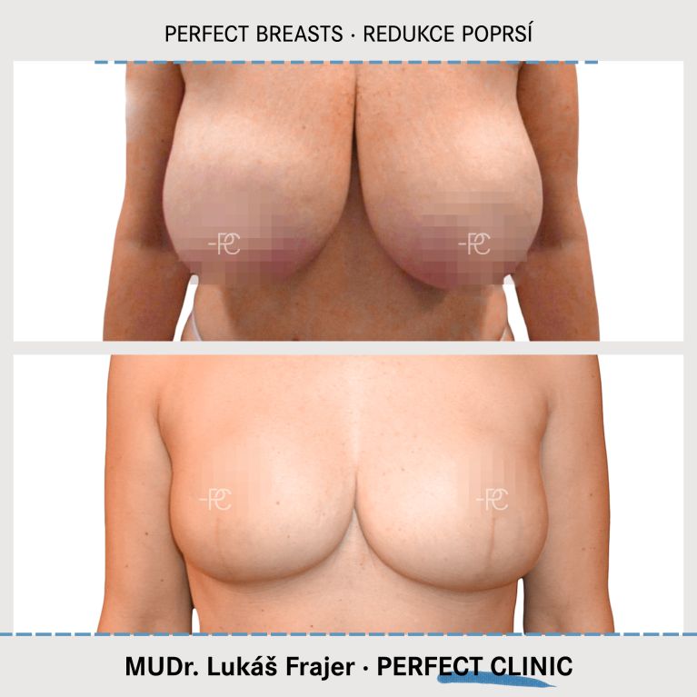 Zmenšení prsou