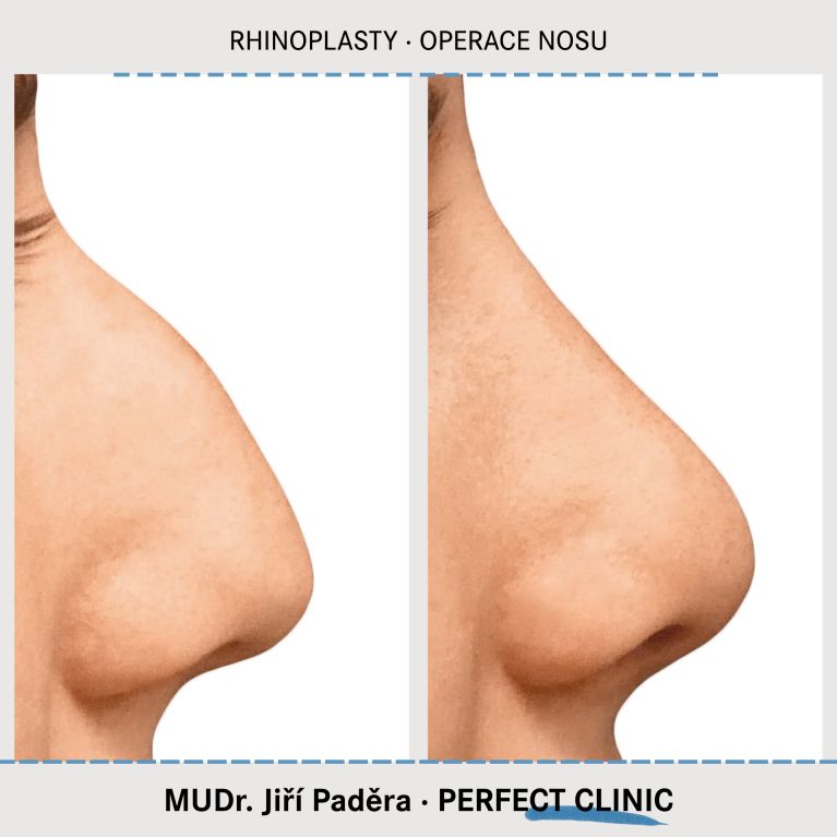 Rhinoplastika