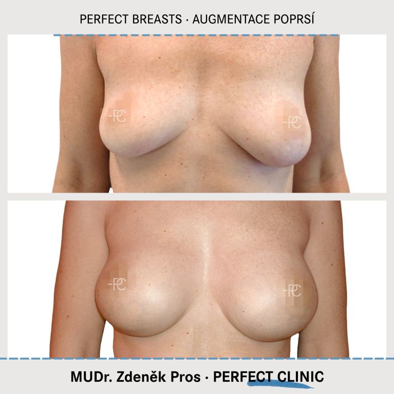 Augmentace poprsí