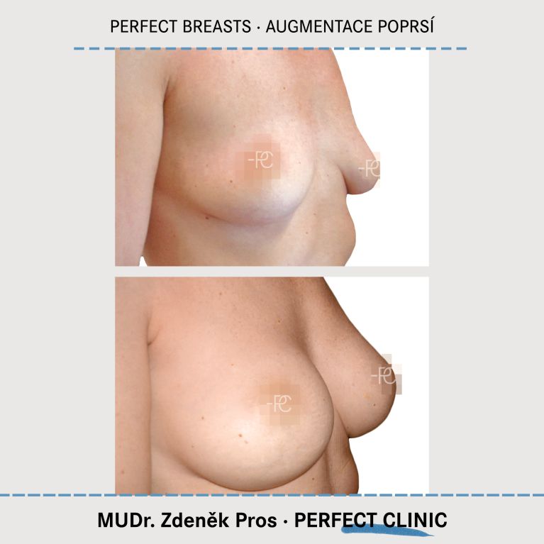 Augmentace poprsí