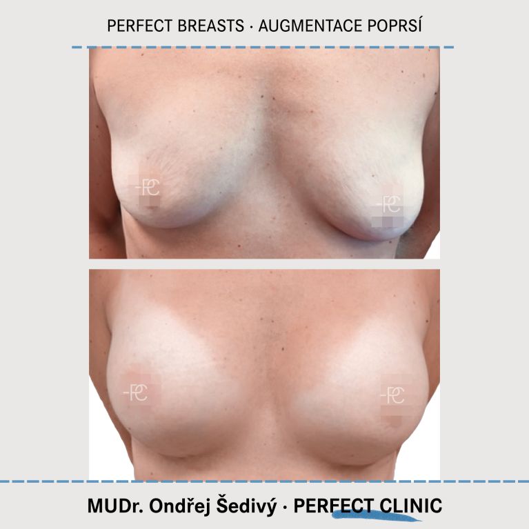 Augmentace poprsí