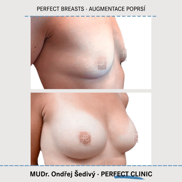 Augmentace poprsí