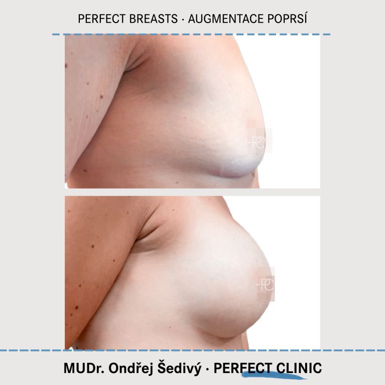 Augmentace poprsí