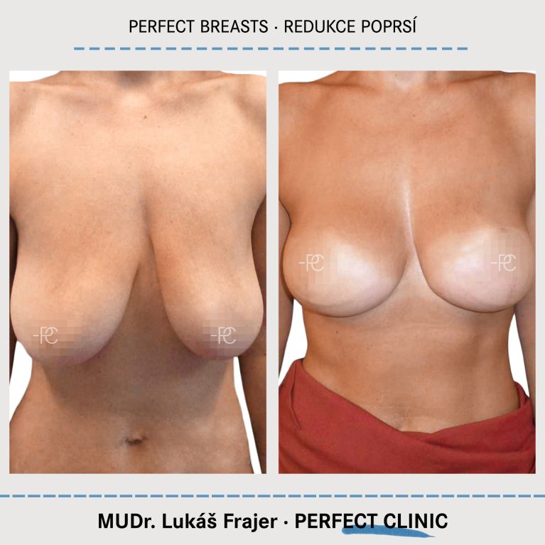 Zmenšení prsou