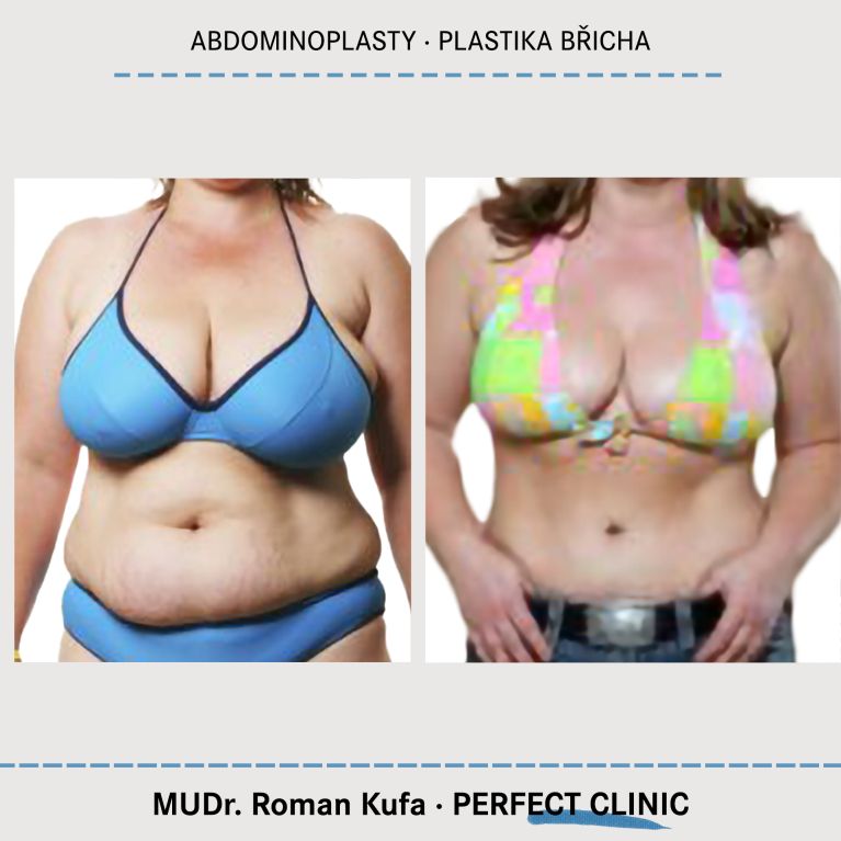 Abdominoplastika