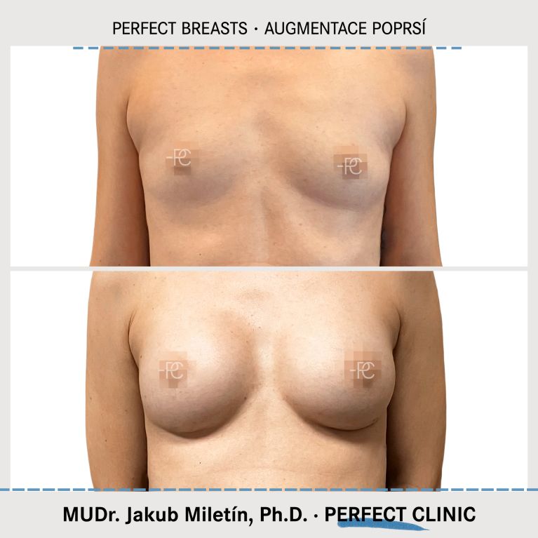 Augmentace poprsí
