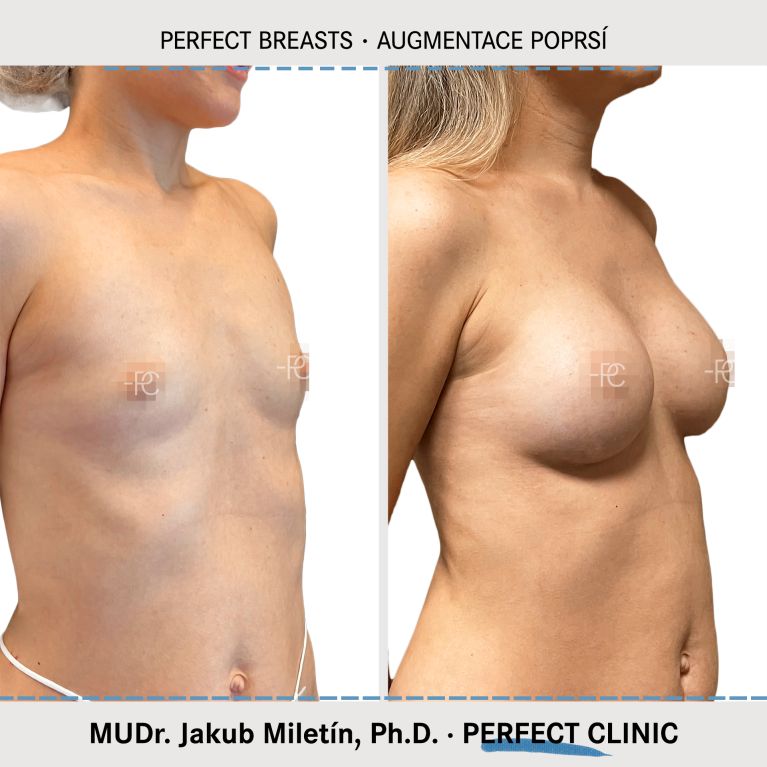 Augmentace poprsí