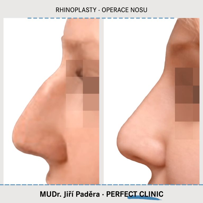 Rhinoplastika