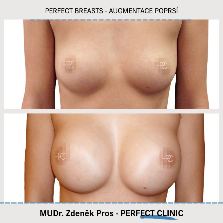 Augmentace poprsí