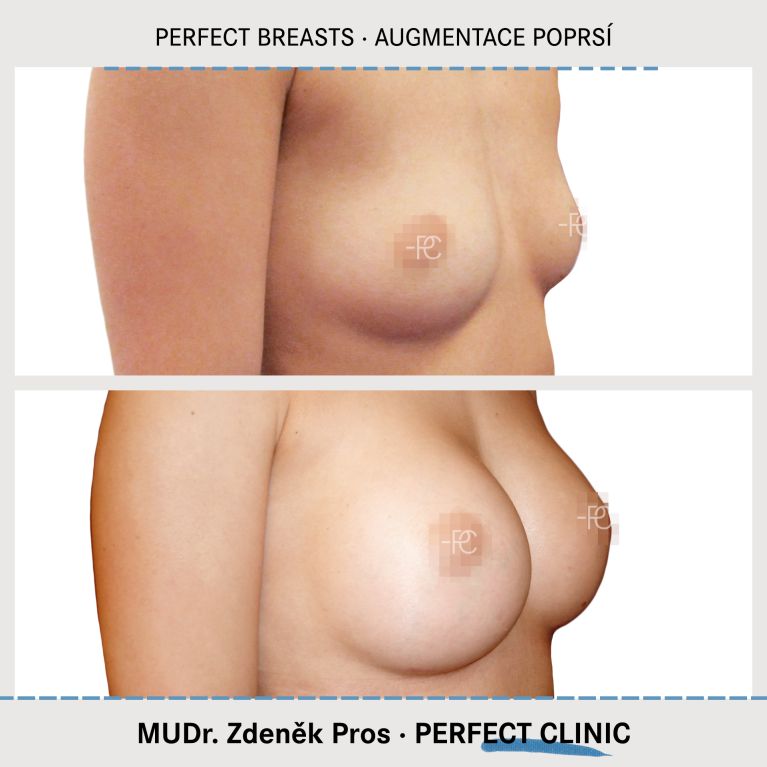 Augmentace poprsí