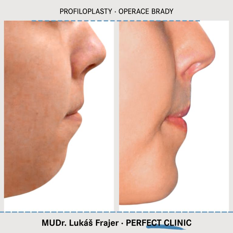 Plastická operace brady