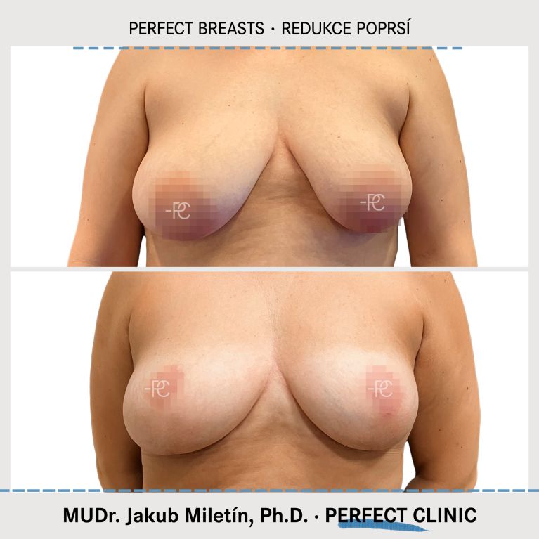 Zmenšení prsou