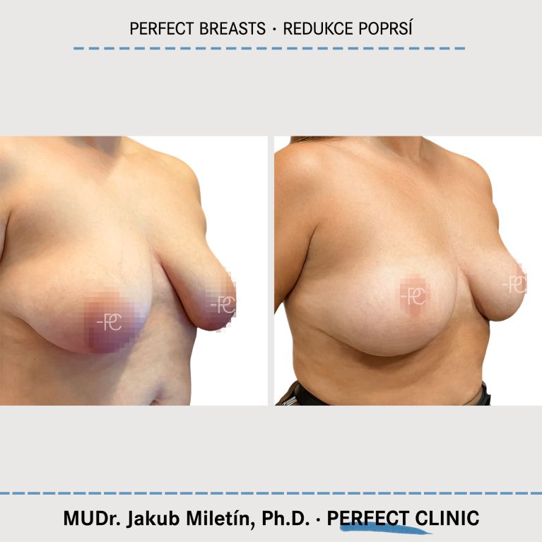 Zmenšení prsou