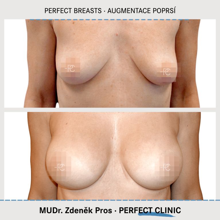 Augmentace poprsí