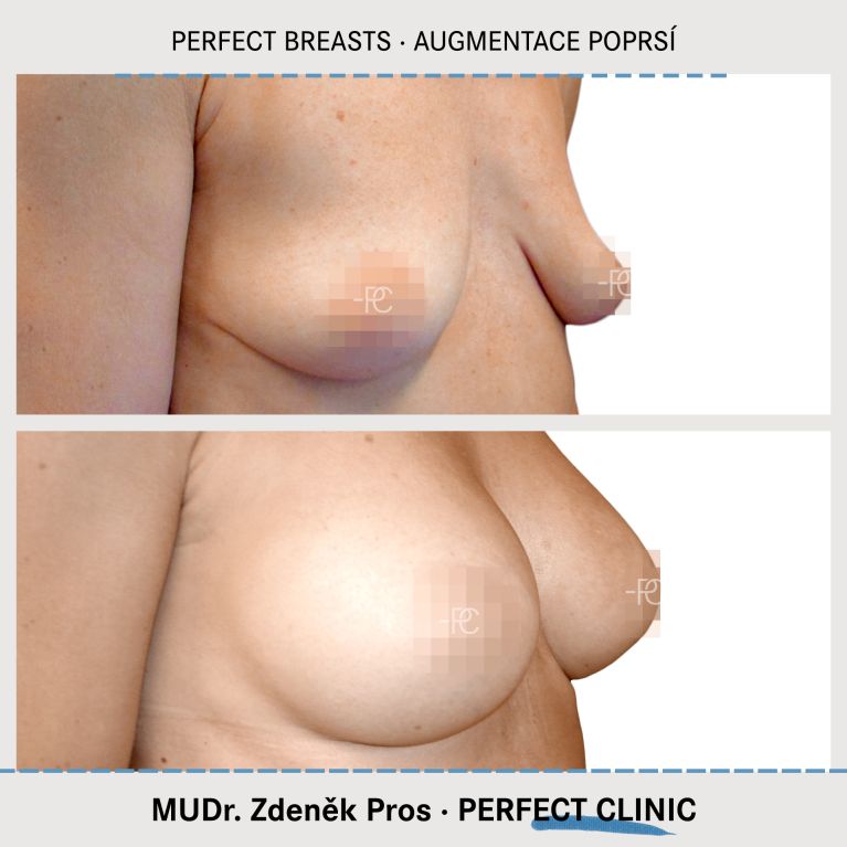 Augmentace poprsí
