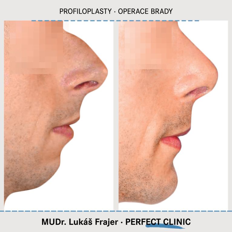 Plastická operace brady