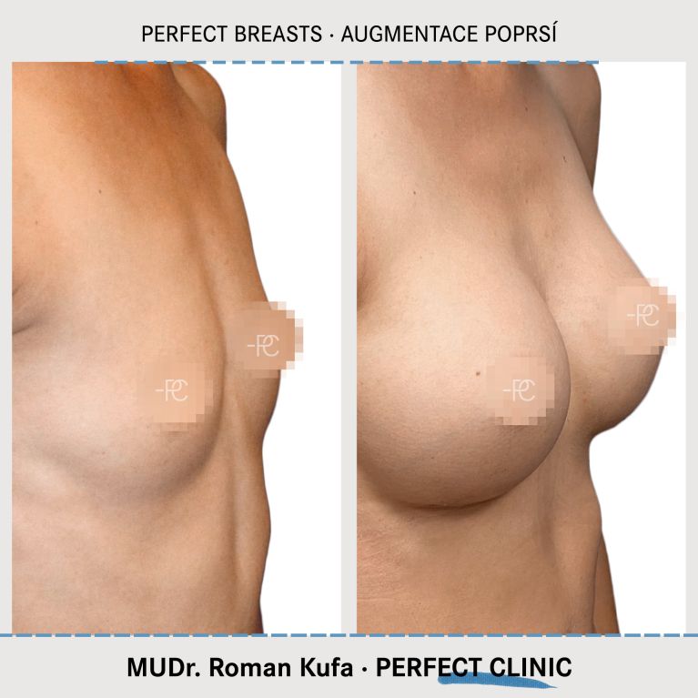 Augmentace poprsí