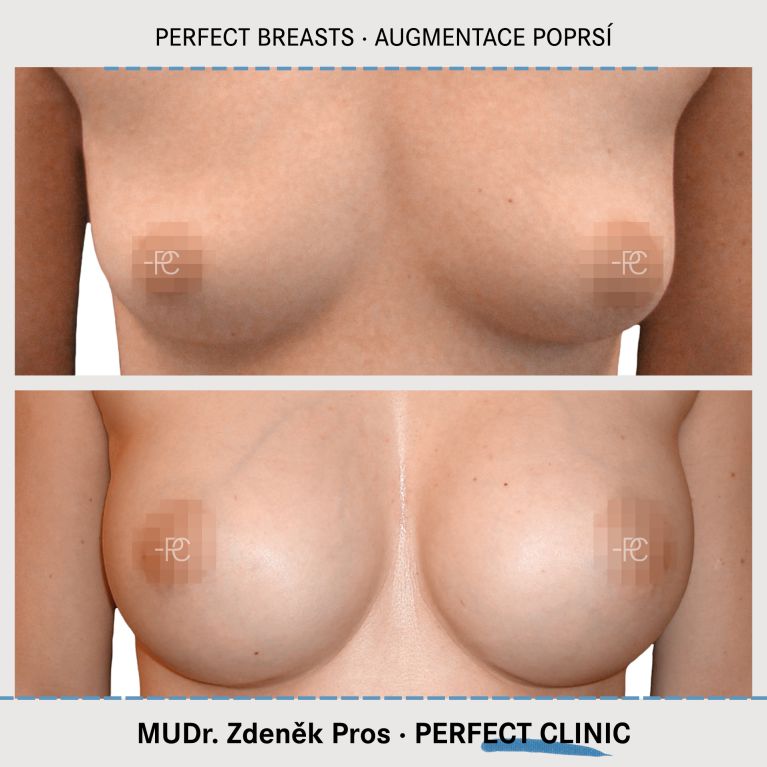 Augmentace poprsí