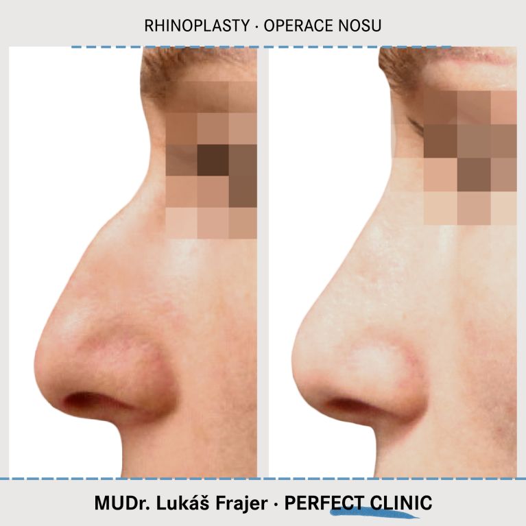 Rhinoplastika