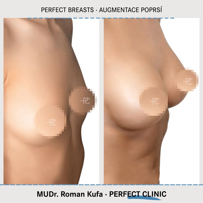Augmentace poprsí