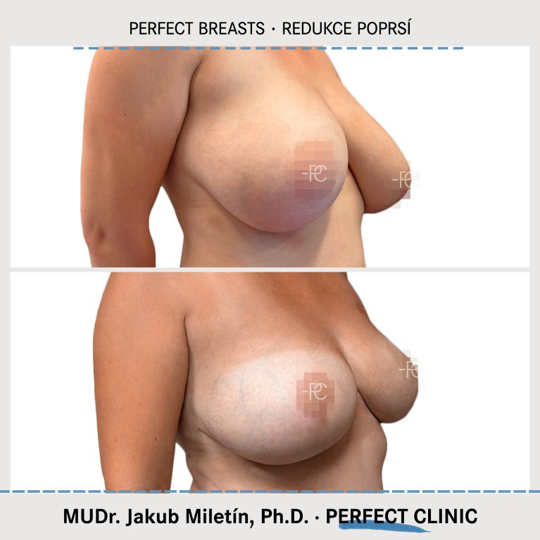 Zmenšení prsou