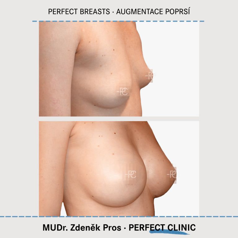 Augmentace poprsí