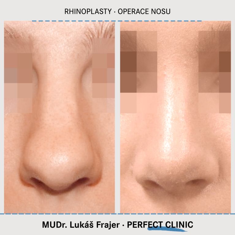 Rhinoplastika