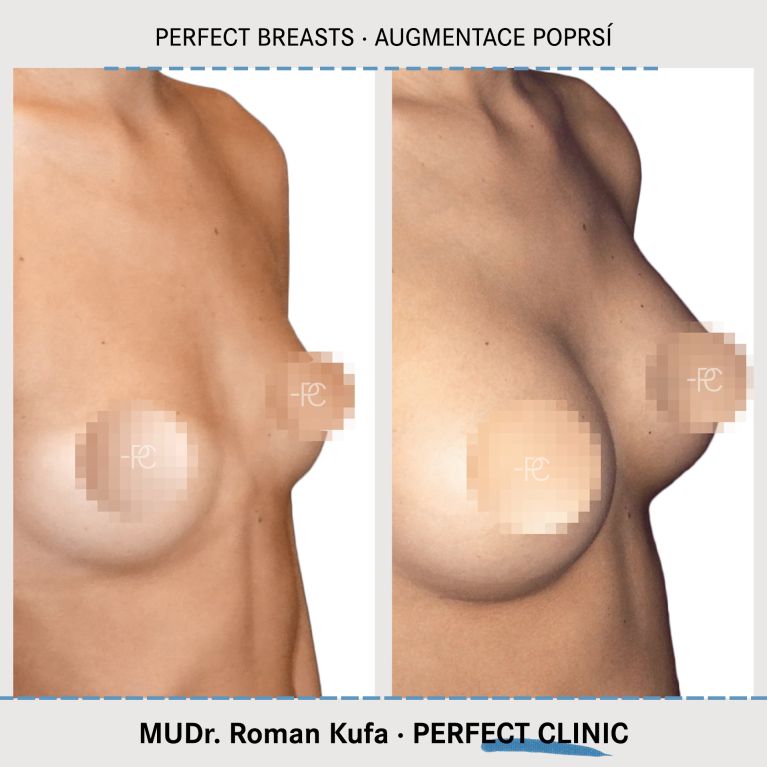 Augmentace poprsí
