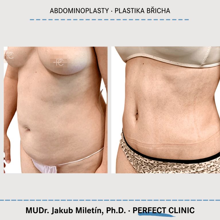 Abdominoplastika