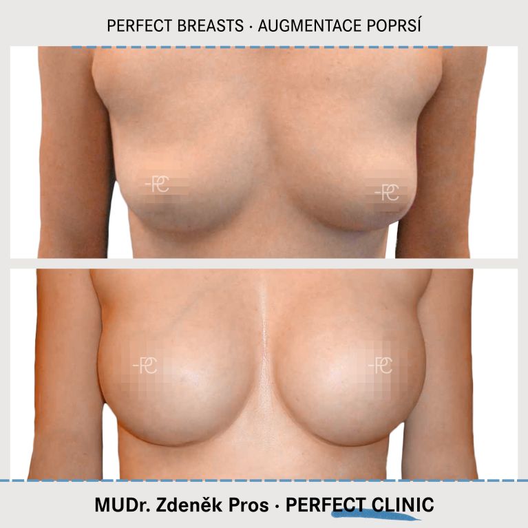 Augmentace poprsí