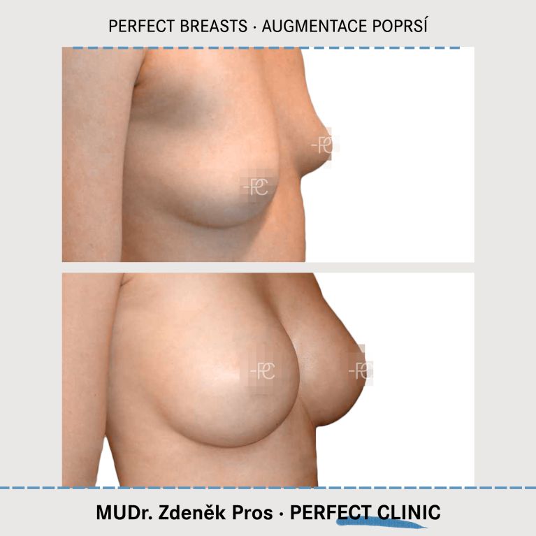 Augmentace poprsí