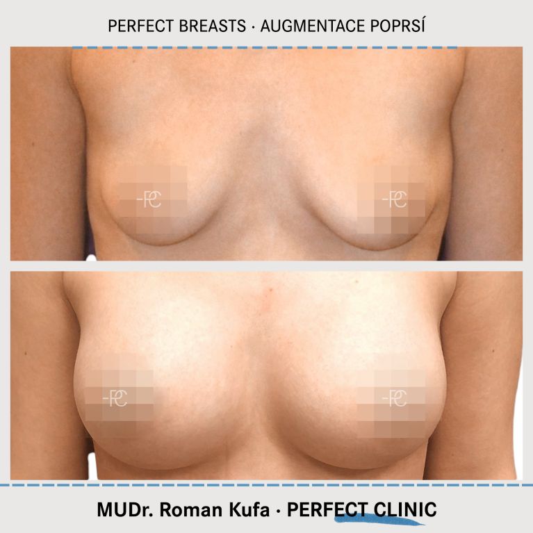 Augmentace poprsí