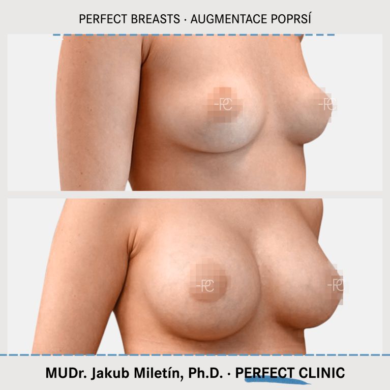 Augmentace poprsí