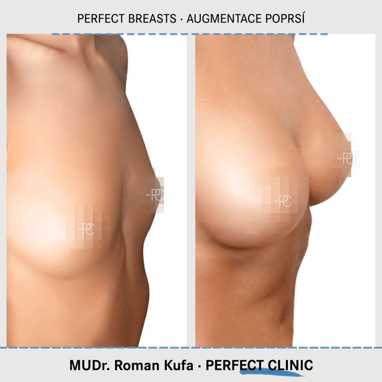 Augmentace poprsí