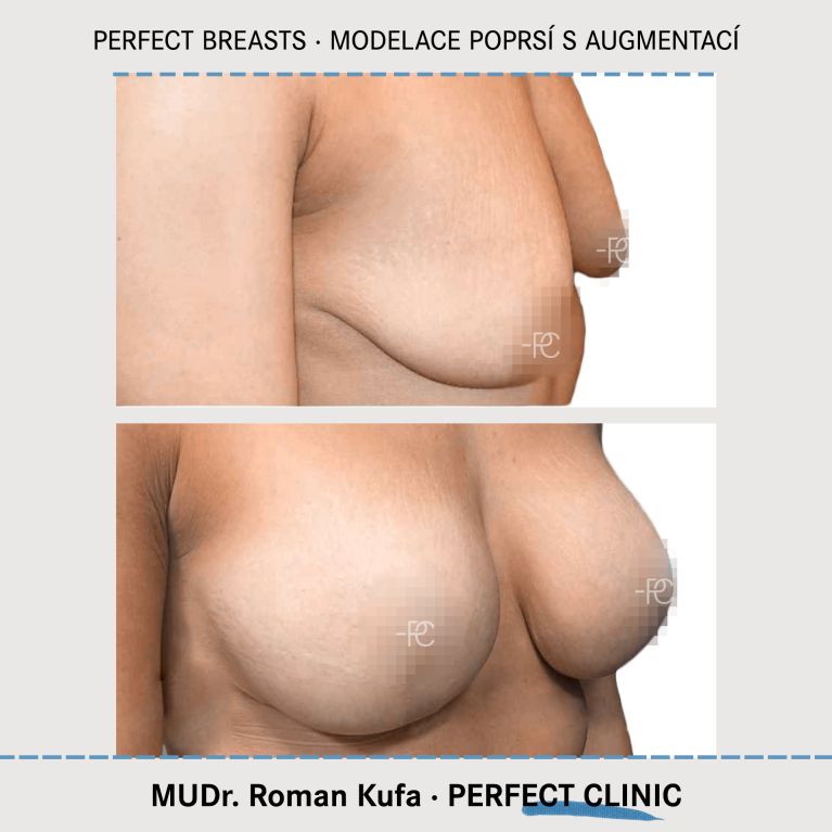 Modelace prsou s augmentací