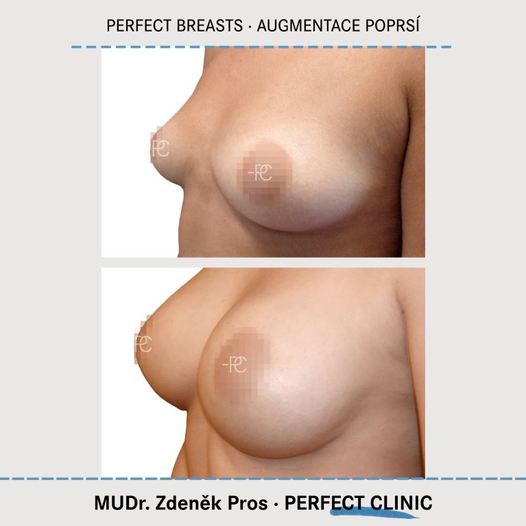 Augmentace poprsí