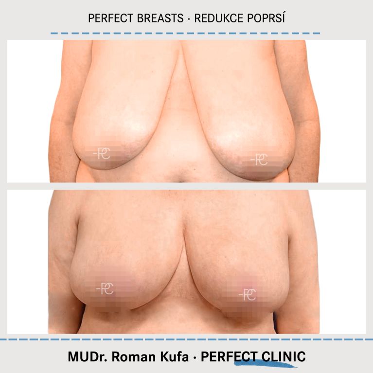 Zmenšení prsou