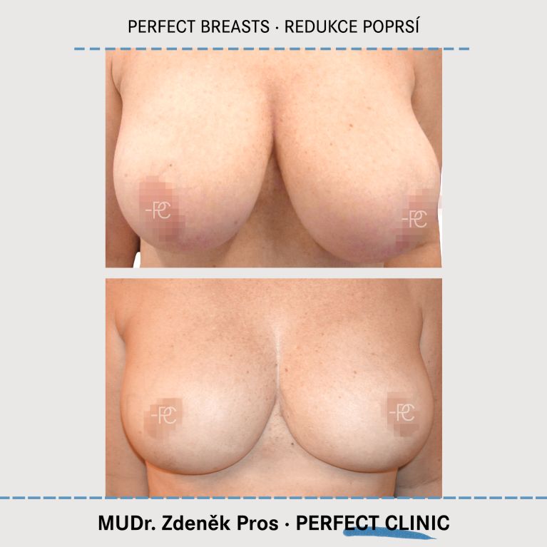 Zmenšení prsou
