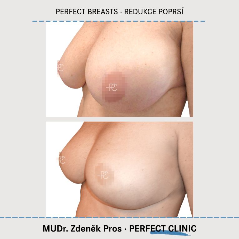 Zmenšení prsou