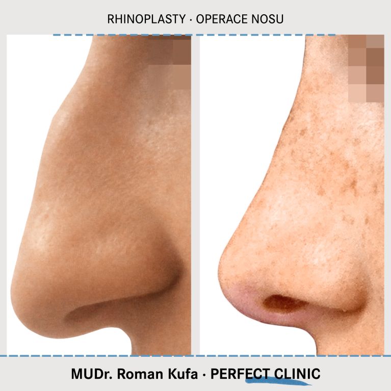 Rhinoplastika