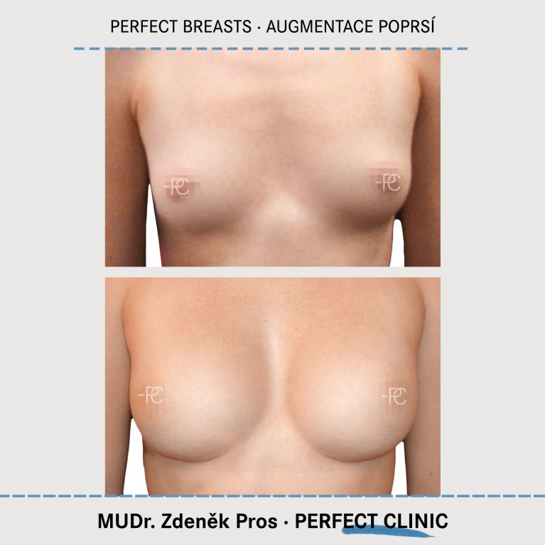 Augmentace poprsí