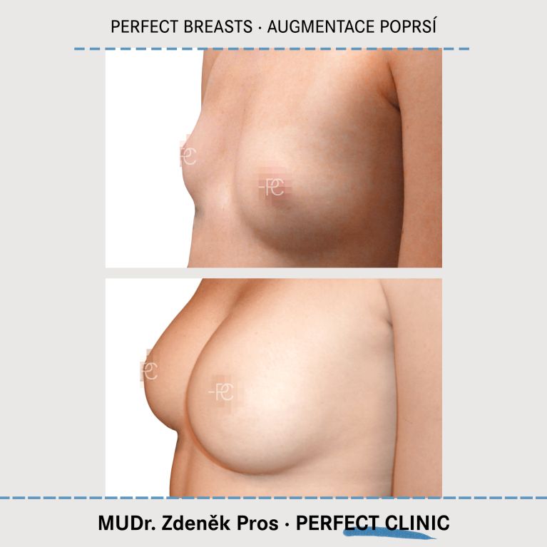 Augmentace poprsí