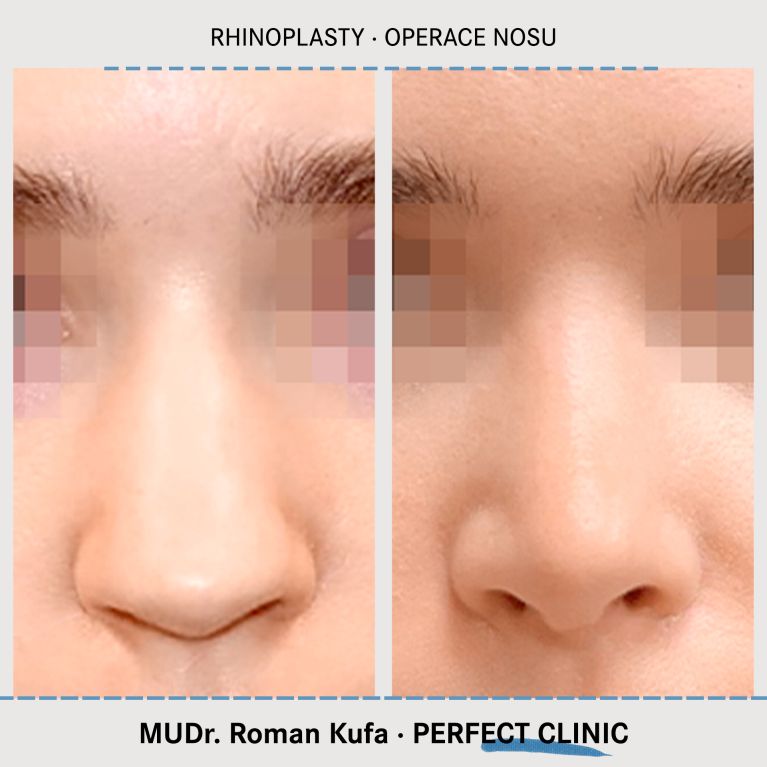 Rhinoplastika