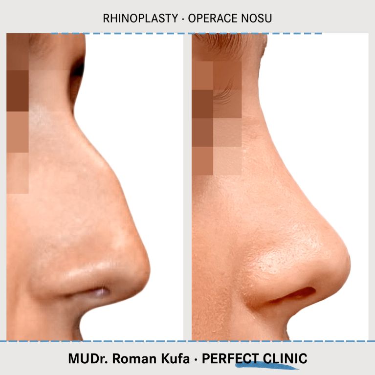 Rhinoplastika