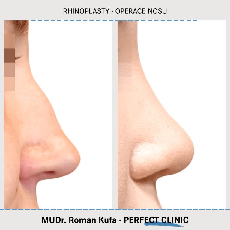 Rhinoplastika