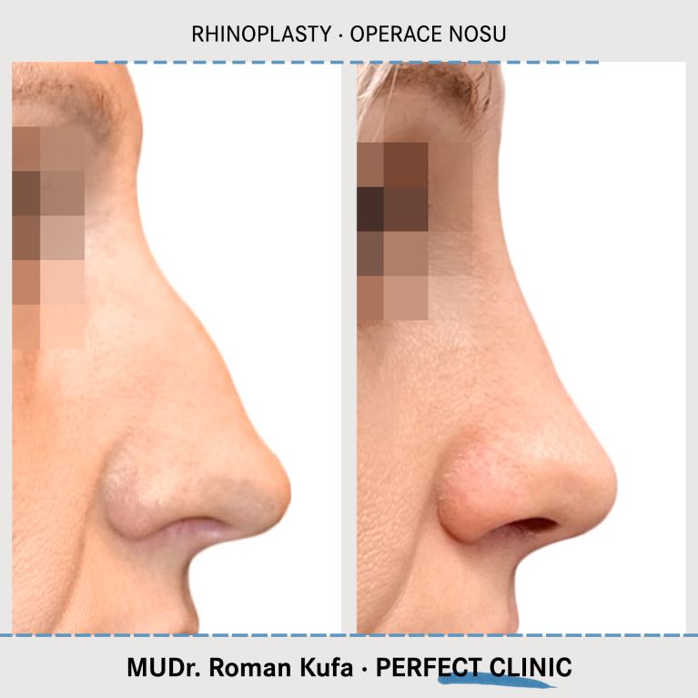 Rhinoplastika